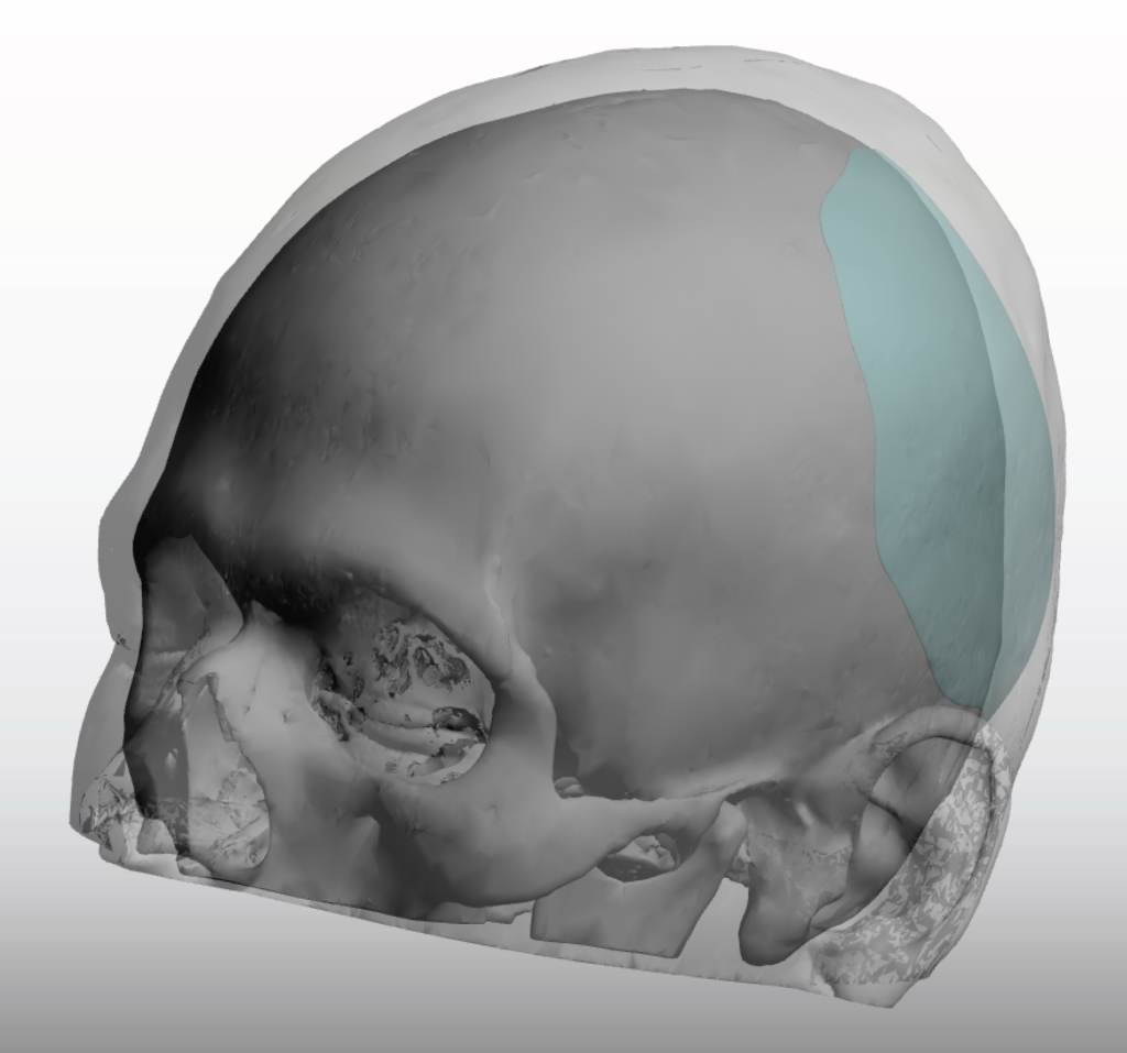 Custom Skull Implants In The Correction Of Occipital Plagiocephaly In