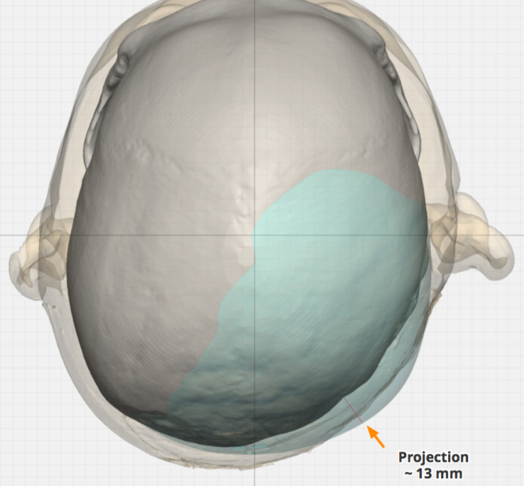 Right Custom Skull Implant For Plagiocephaly Thickness Dr Barry Eppley