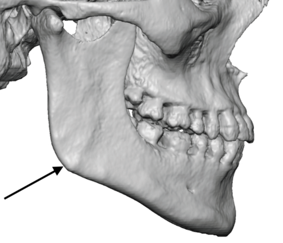 The 3D Anatomy of the Jaw Angles and Its Implication in Custom Jawline  Implant Designs - Explore Plastic Surgery