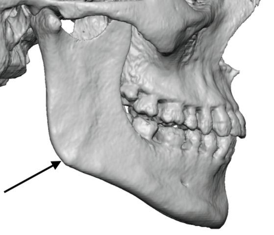 The 3D Anatomy of the Jaw Angles and Its Implication in Custom Jawline ...