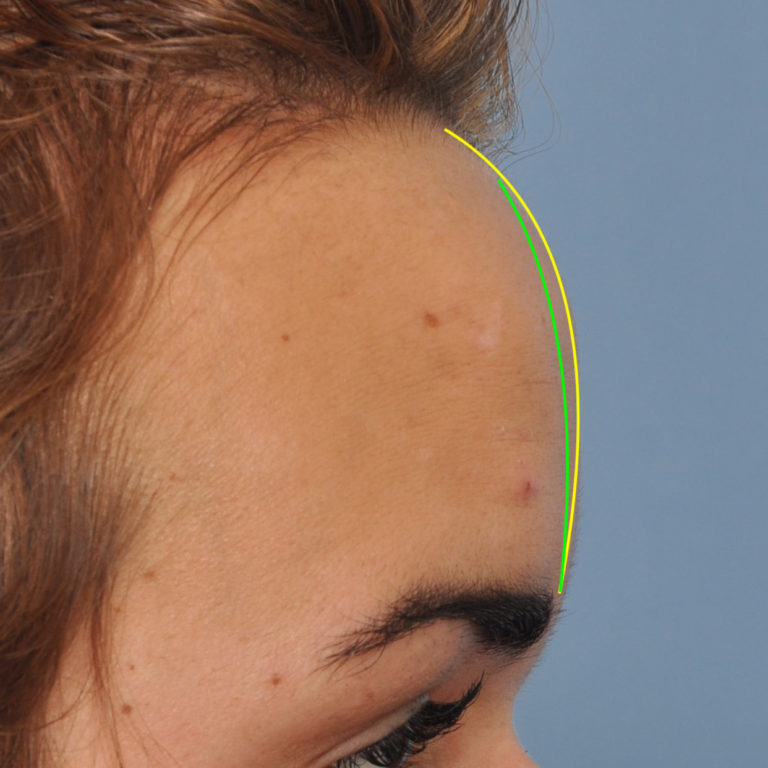 Plastic Surgery Case Study Frontal Hairline Advancement with Frontal