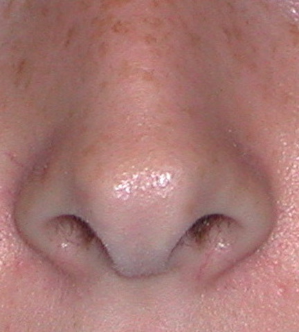 bifid nose tip
