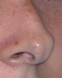 cleft nose tip