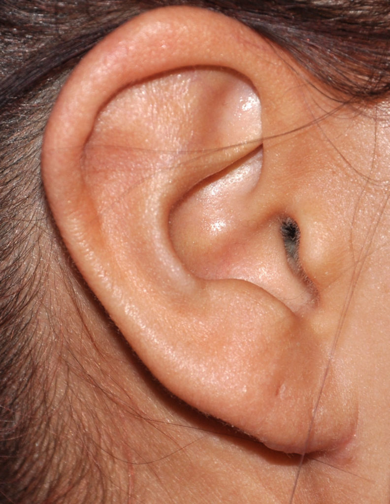 Earlobe Reduction of the AgeRelated Long Ear Explore Plastic Surgery