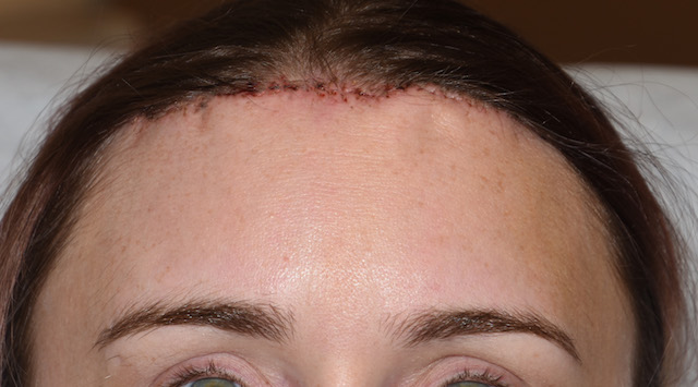 female frontal hairline advancement after Dr Barry Eppley Indianapolis ...