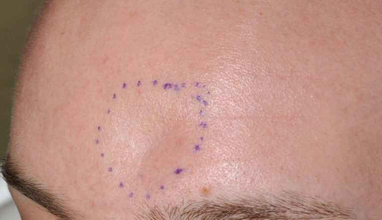 forehead-dent-outlines-oblique-view-dr-barry-eppley-indianapolis