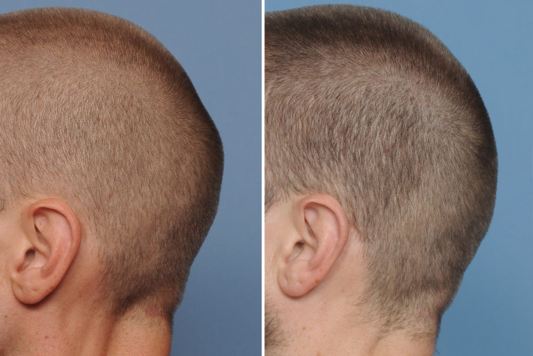 Male Occipital Skull Reduction Result Side View Dr Barry Eppley