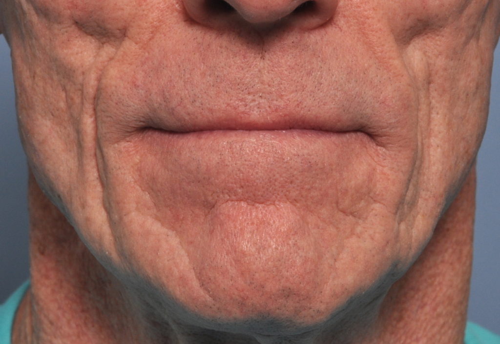 Technical Strategies Direct Placement of Cheek DermalFat Grafts In