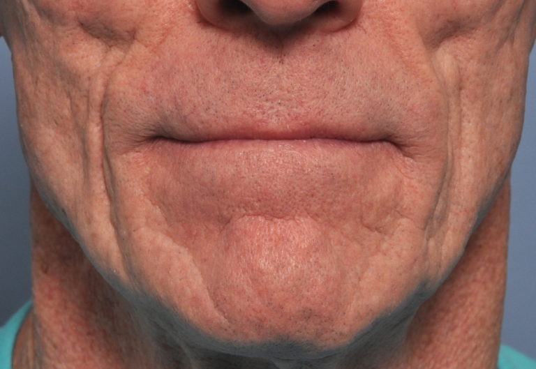 Technical Strategies Direct Placement of Cheek DermalFat Grafts In