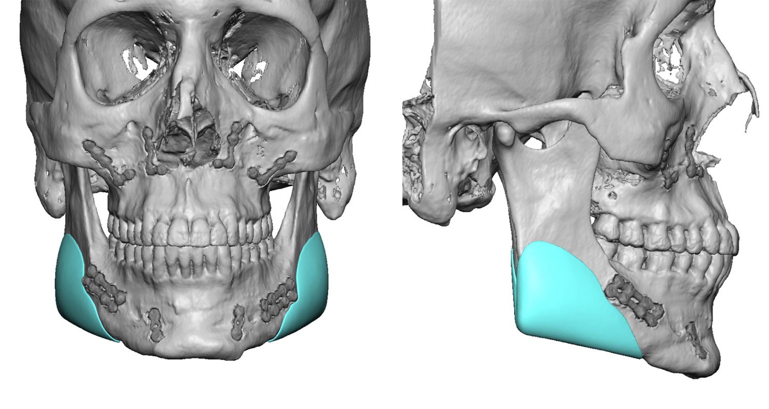 custom-jaw-angle-implant-design-dr-barry-eppley-indianapolis - Explore  Plastic Surgery