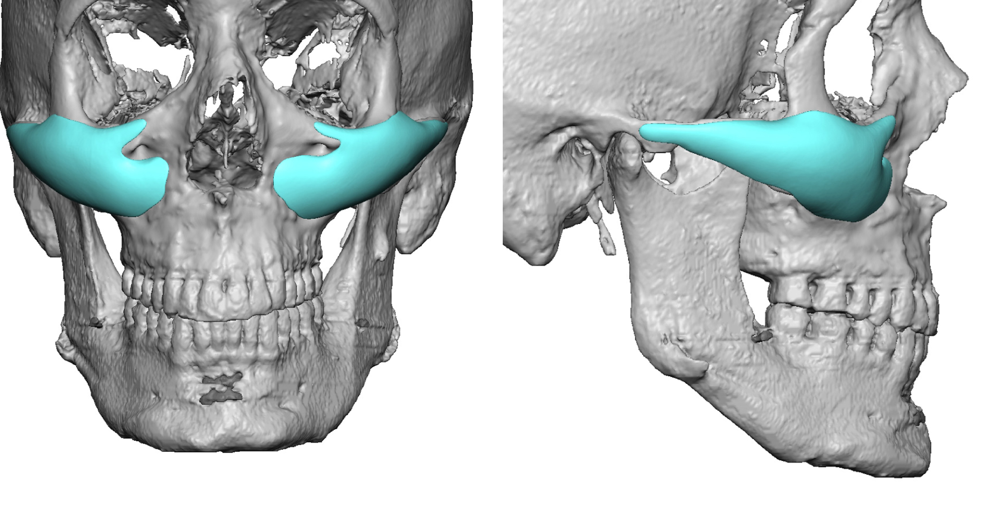 Custom Facial Implants - IV. The High Cheekbone Look - Explore Plastic ...