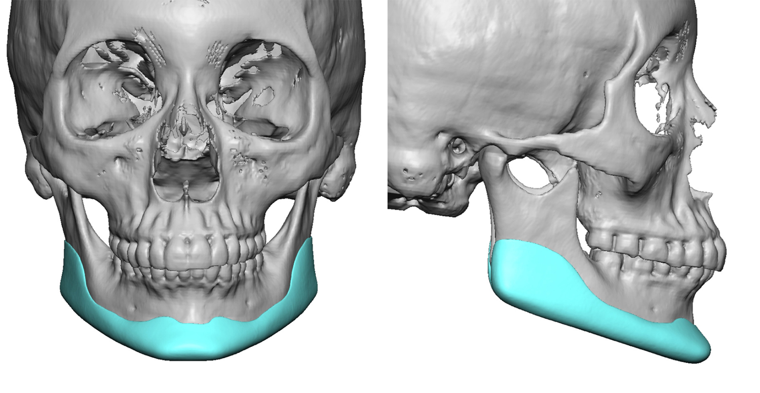 Female custom jawline implant design Dr Barry Eppley Indianapolis ...