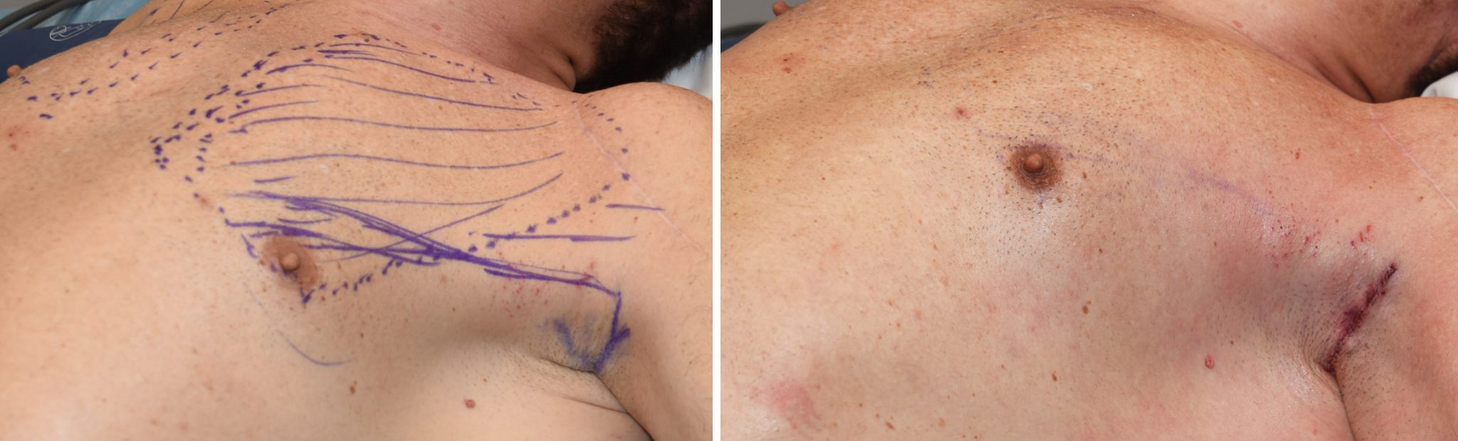 Left Pectoral Implant after Bilateral Shoulder Replacement