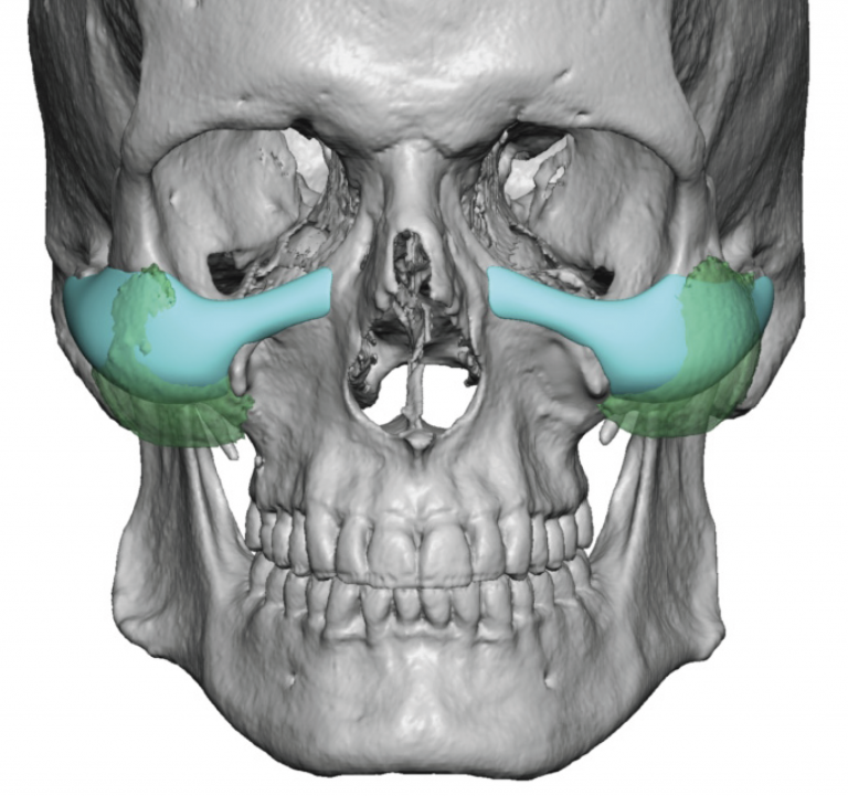 Plastic Surgery Case Study - Male Custom Cheek Implant Replacements for ...