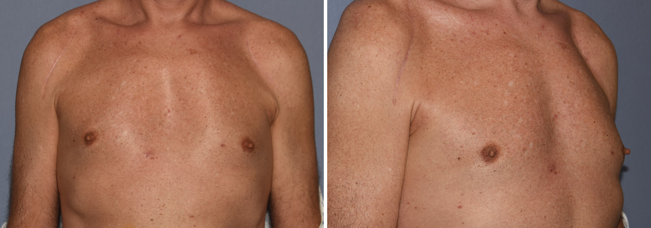 Male Pectoal Implants after Bilateral Shoulder Replacement