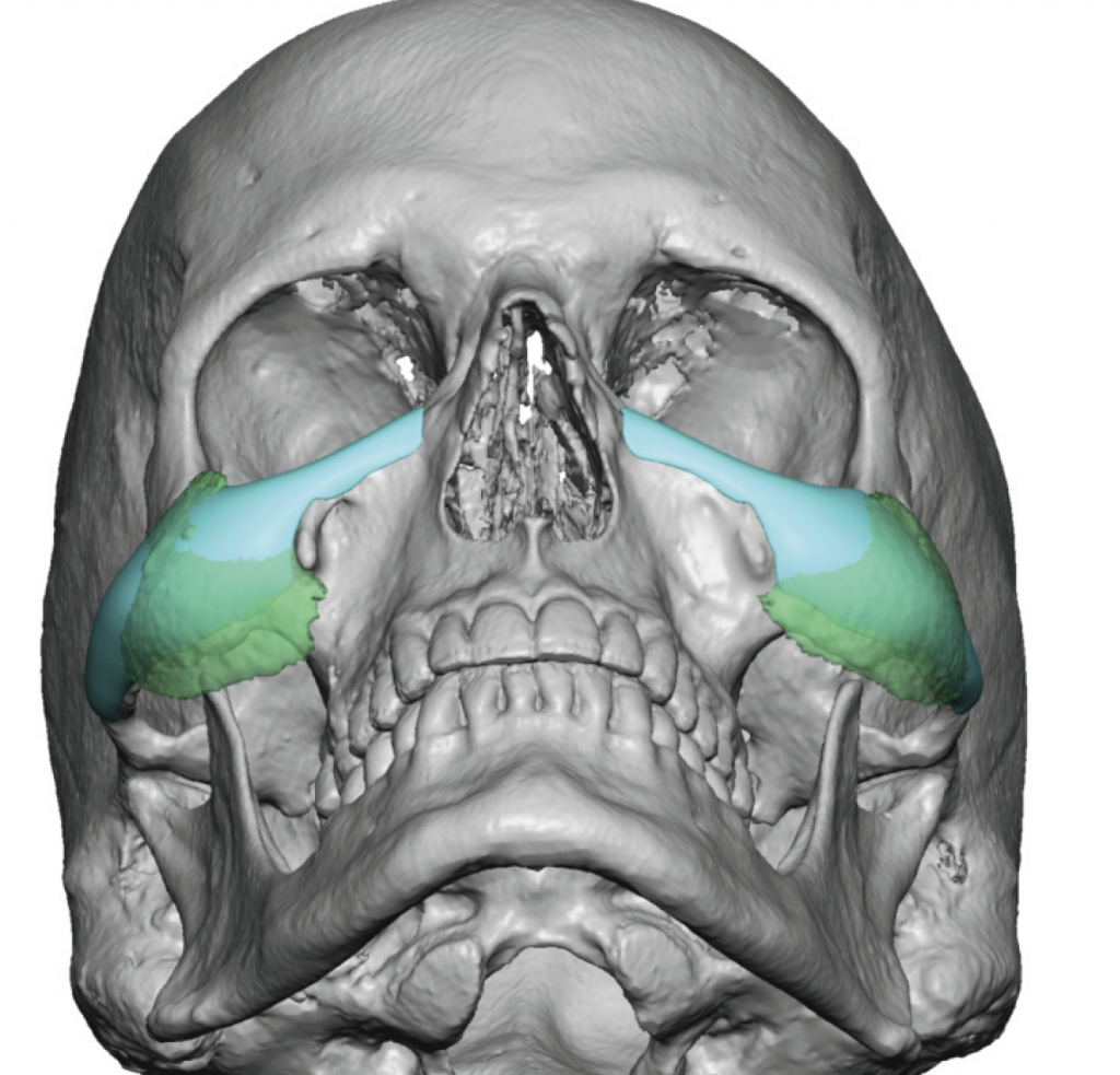 plastic-surgery-case-study-male-custom-cheek-implant-replacements-for