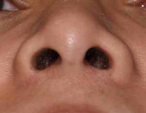 Plastic Surgery Case Study - Nostril Narrowing in the Short Nose ...