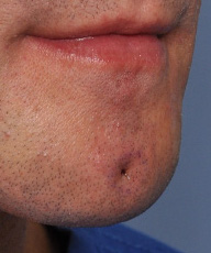 The Tom Brady Chin Dimple Procedure - Explore Plastic Surgery