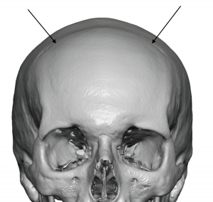 dip skull coronal implant custom surgery plastic study case