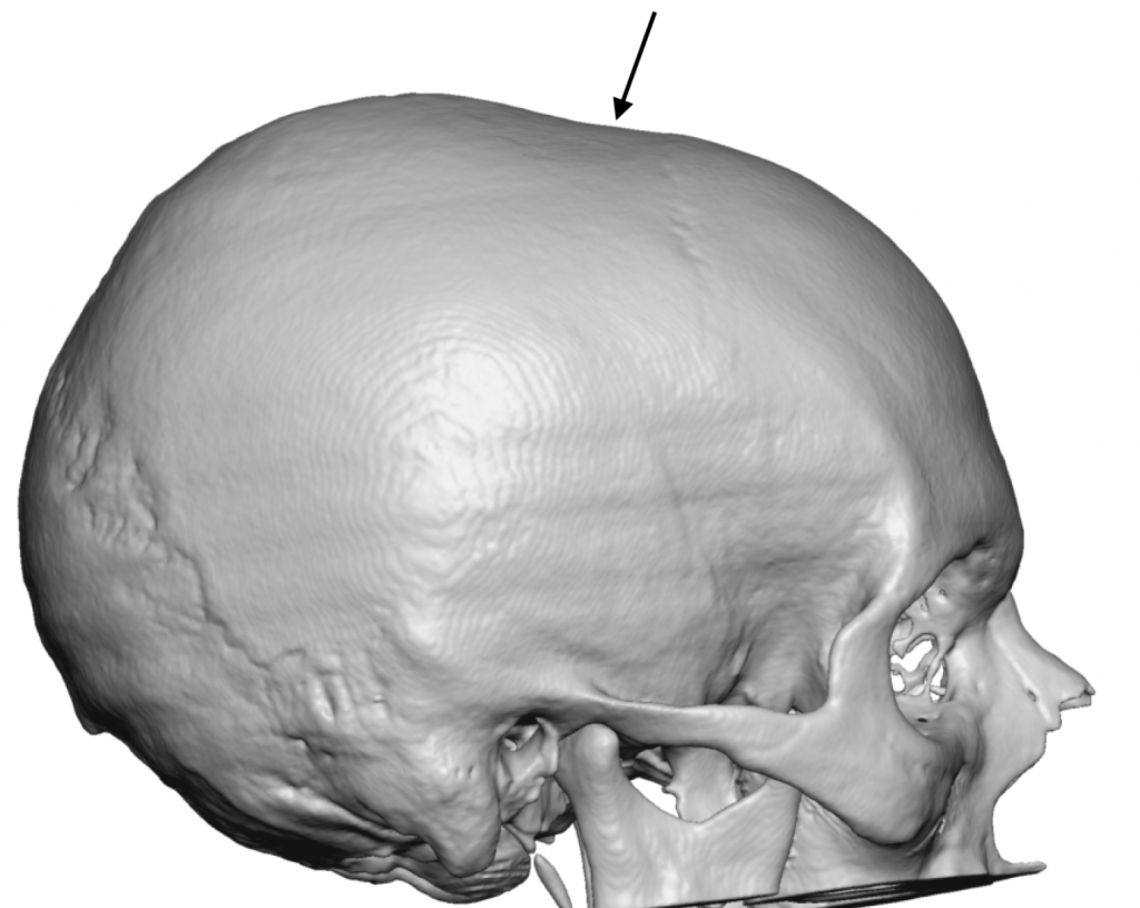 Coronal Dip Skull Defect side view 3D CT scan Dr Barry Eppley ...