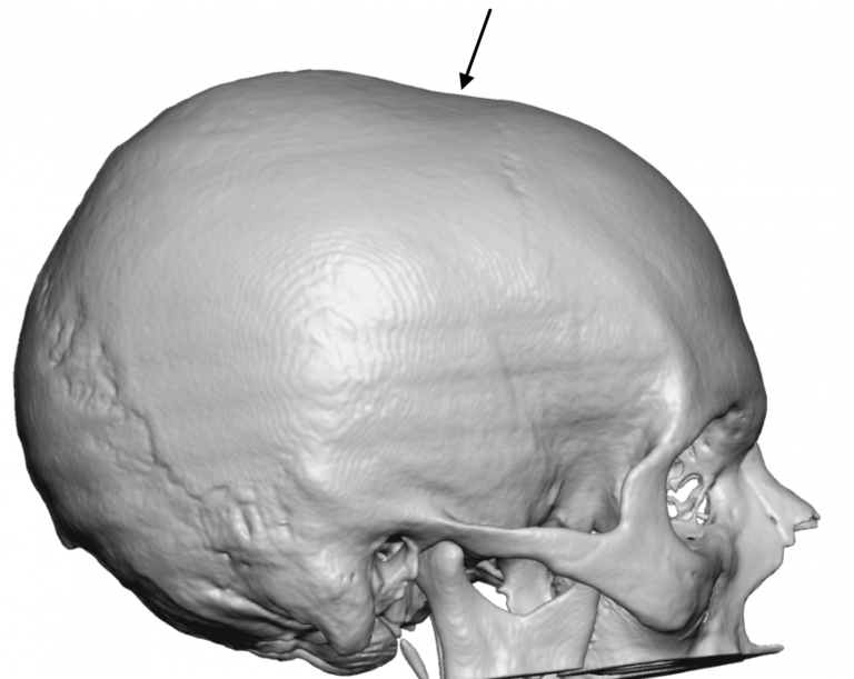 Coronal Dip Skull Defect side view 3D CT scan Dr Barry Eppley