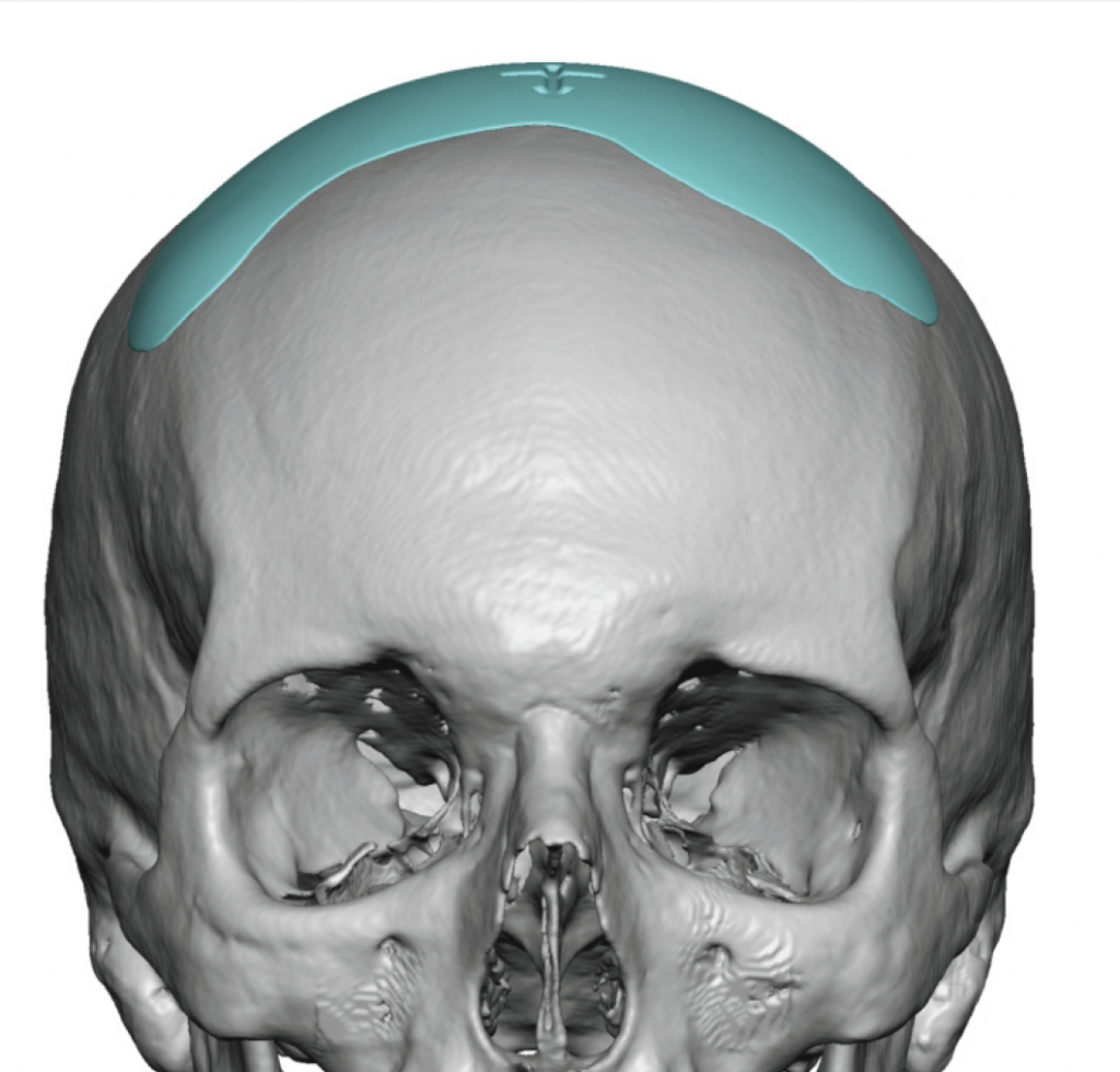 Coronal Dip custom skul implant design front view Dr Barry Eppley ...