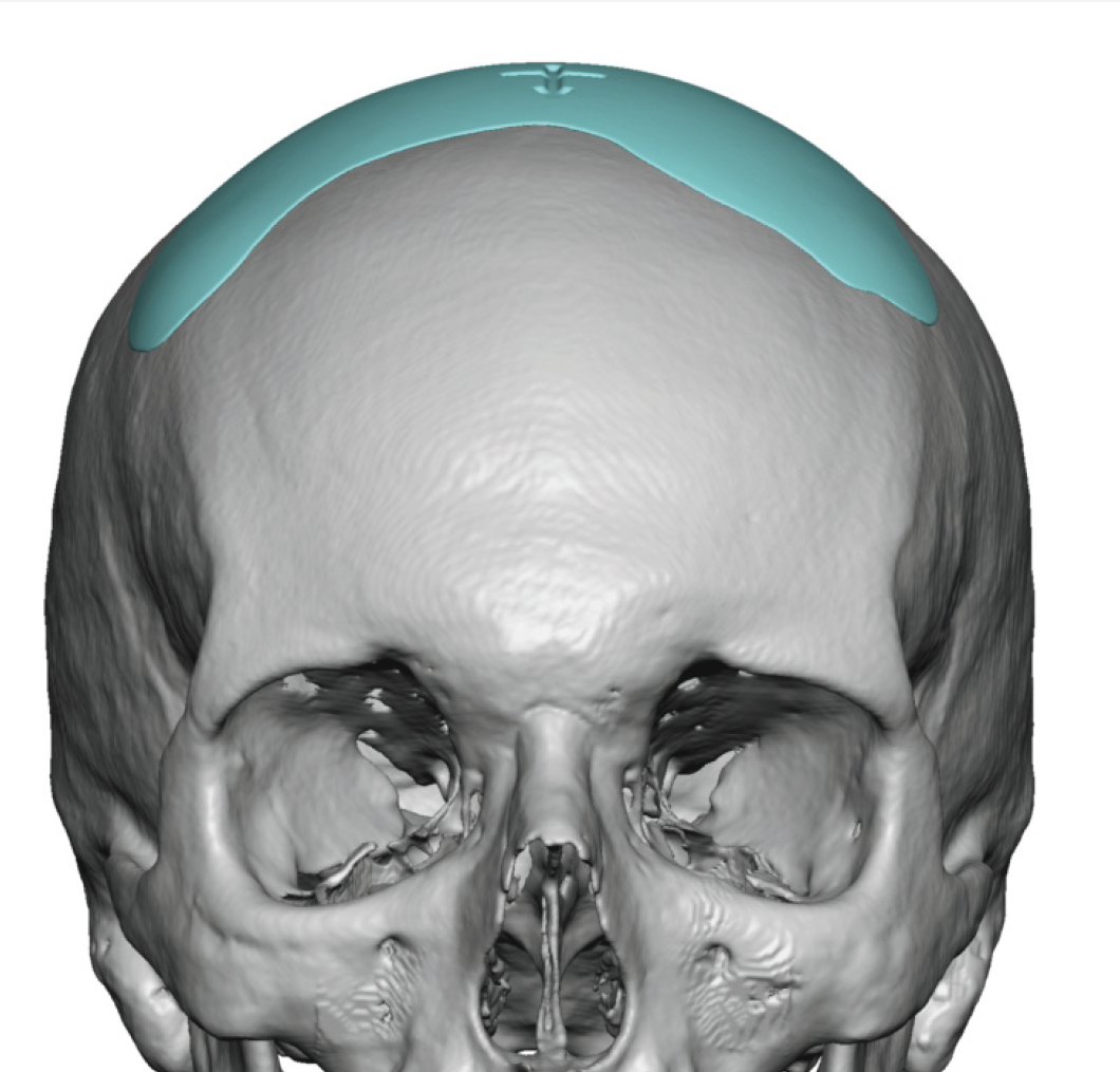 Plastic Surgery Case Study - The Coronal Dip Custom Skull Implant 