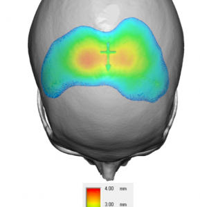 Plastic Surgery Case Study The Coronal Dip Custom Skull Implant Explore Plastic Surgery