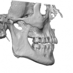 Flat mandibular plane angle side view Dr Barry Eppley Indianapolis ...