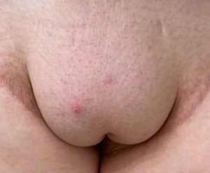 https://exploreplasticsurgery.com/wp-content/uploads/2020/06/Pubic-Lift-before-front-view-Dr-Barry-Eppley-Indianapolis-300x247.jpg