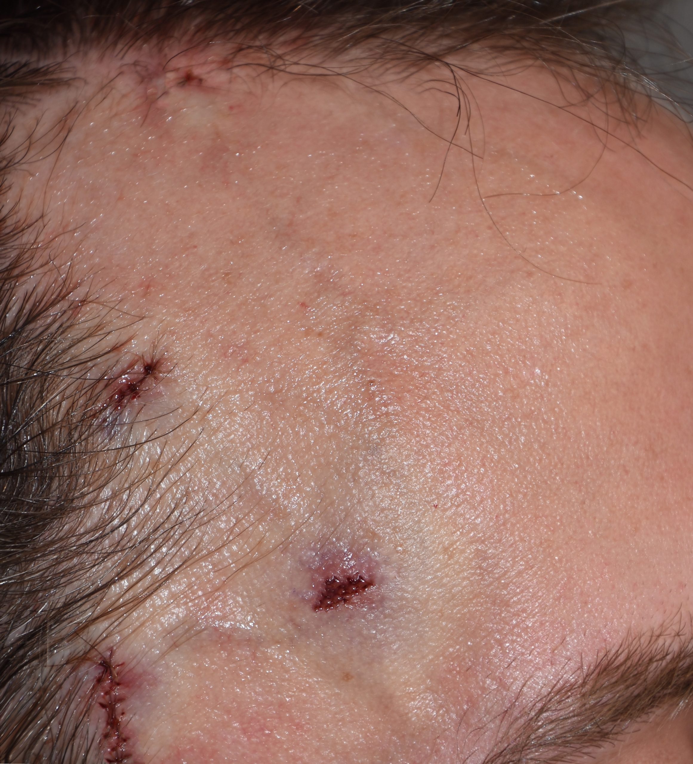 Right Temporal Artery Ligations after intraop Dr Barry Eppley ...