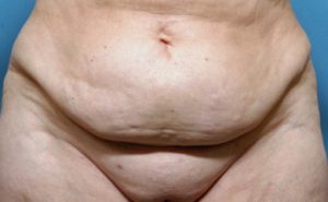 Plastic Surgery Case Study - Pubic Lift with Liposuction for Mons Reduction  and Urinary Tract Infection Cure - Explore Plastic Surgery