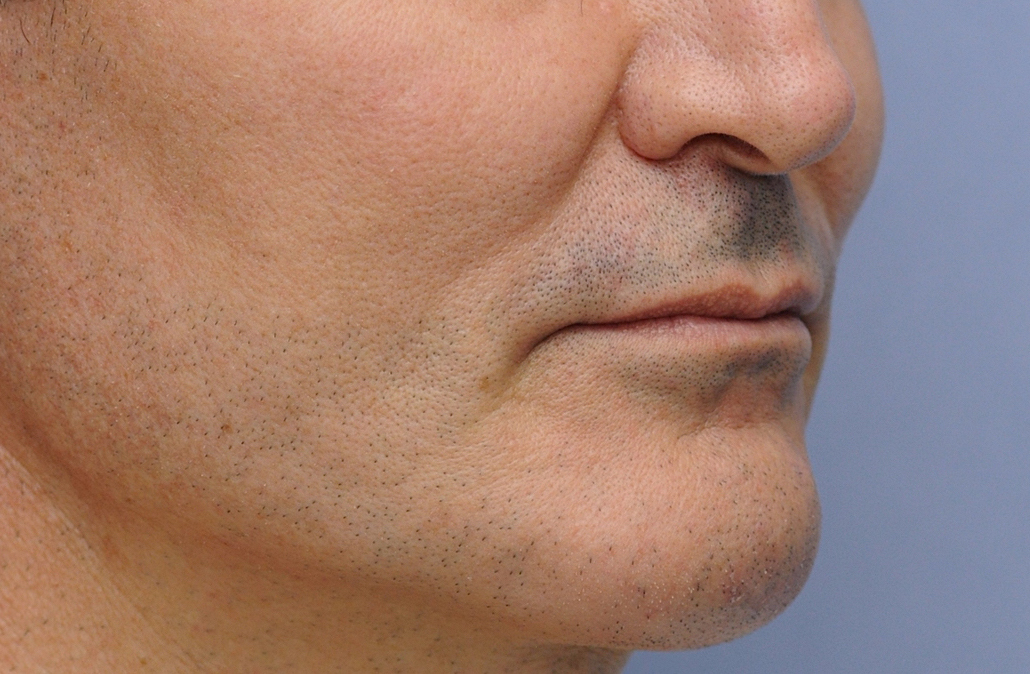 Plastic Surgery Case Study Vertical Lengthening Custom Jawline Implant And Lower Facial