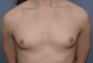 Breast augmentation transgender images.dujour.com: over