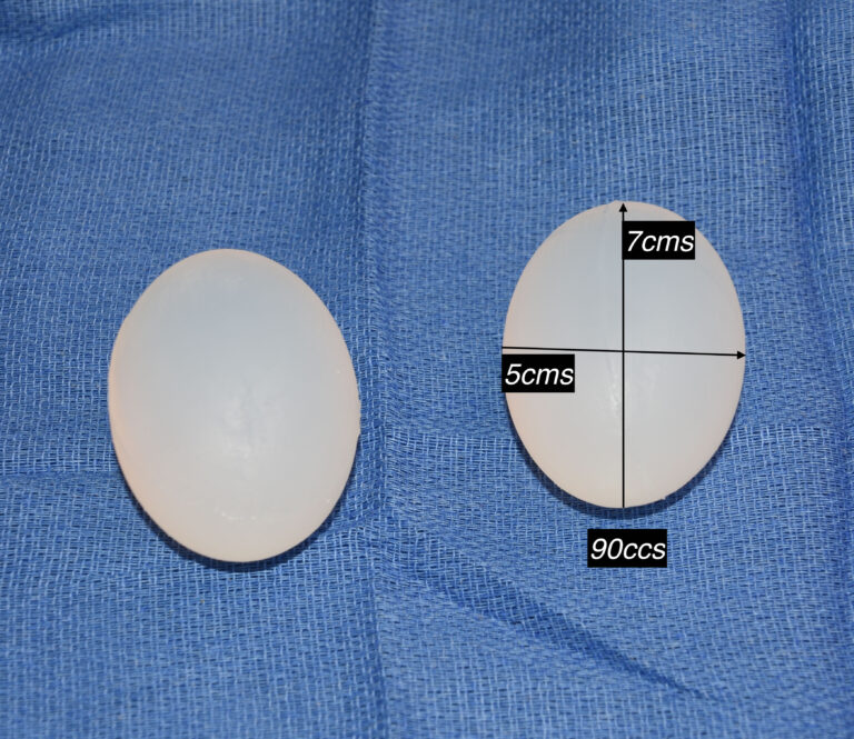 Plastic Surgery Case Study Large Custom Testicle Implants In The Penile Prosthesis Patient