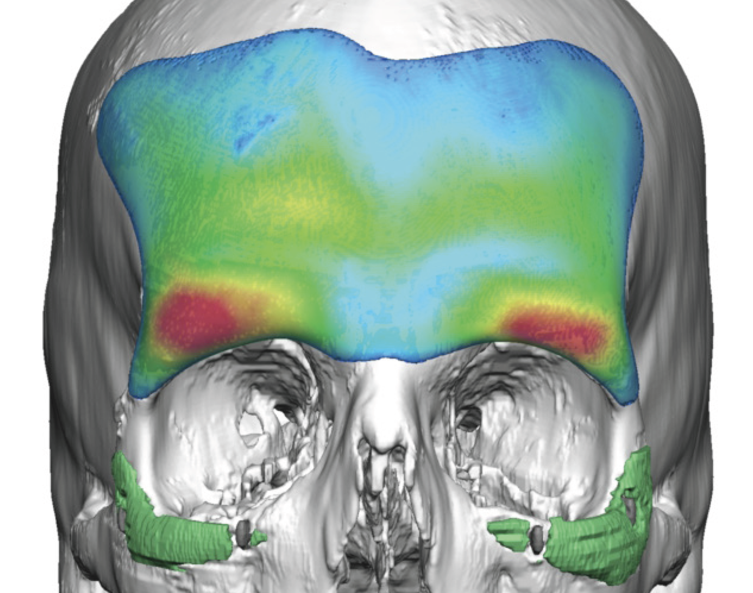Forehead Brow Bone Implant design thicknesses front view Dr Barry