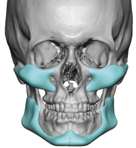 Male custom facial masculinization implants front view Dr Barry Eppley ...