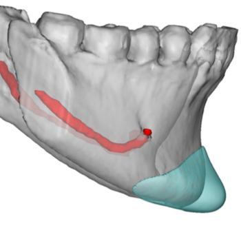 chin implant Archives - Explore Plastic Surgery