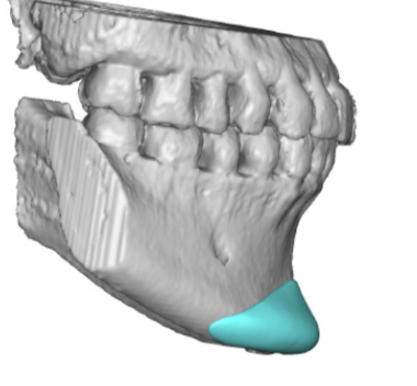 Plastic Surgery Case Study - Combining A Custom Chin Implant with ...