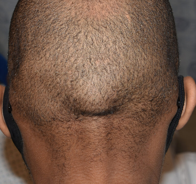 Plastic Surgery Case Study - Anatomic Bony Reduction In The Occipital