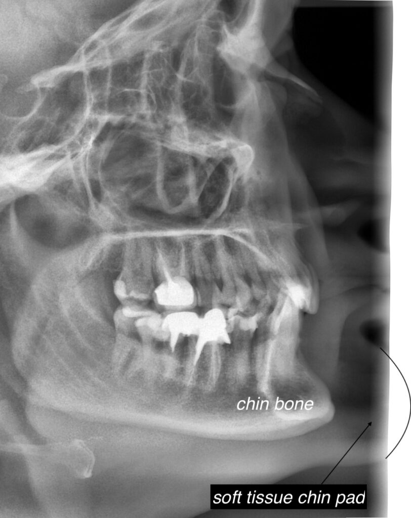 Plastic Surgery Case Study Chin Reduction With Submental Resection Of