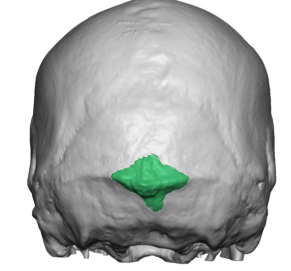 Plastic Surgery Case Study Anatomic Bony Reduction In The Occipital