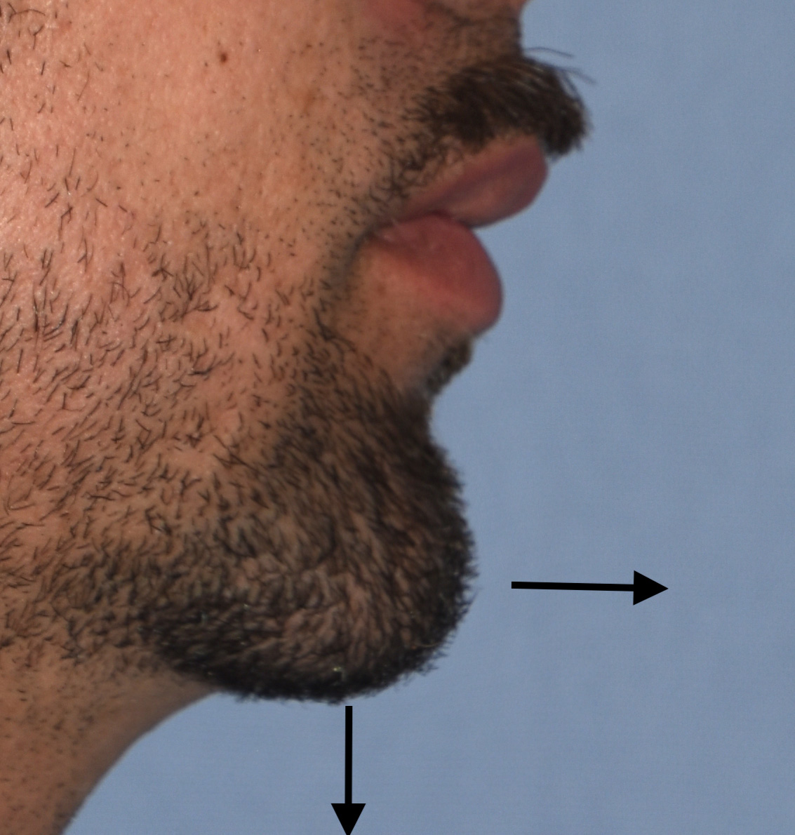 Plastic Surgery Case Study - Ensuring Soft Tissue Chin Pad Redraping in ...