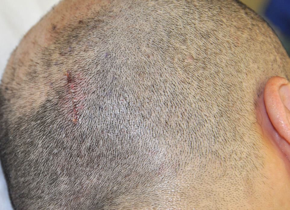 Anatomy and Technique of Skull Bump and Osteoma Removal Explore