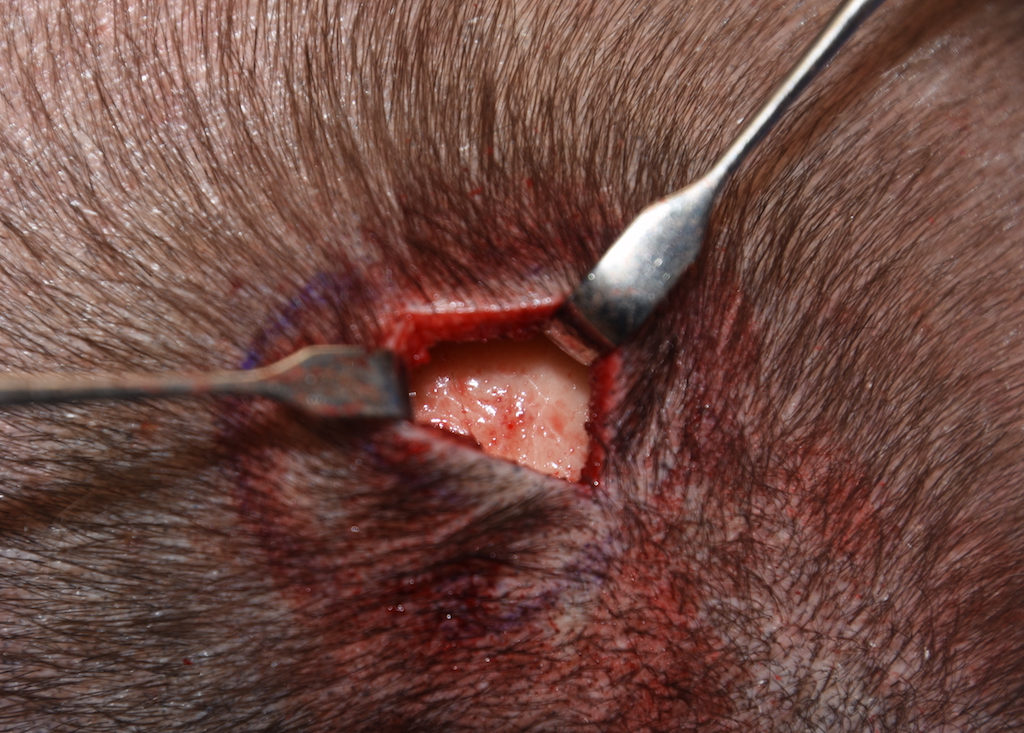 skull bump reduction intraop Dr Barry Eppley indianapolis - Explore