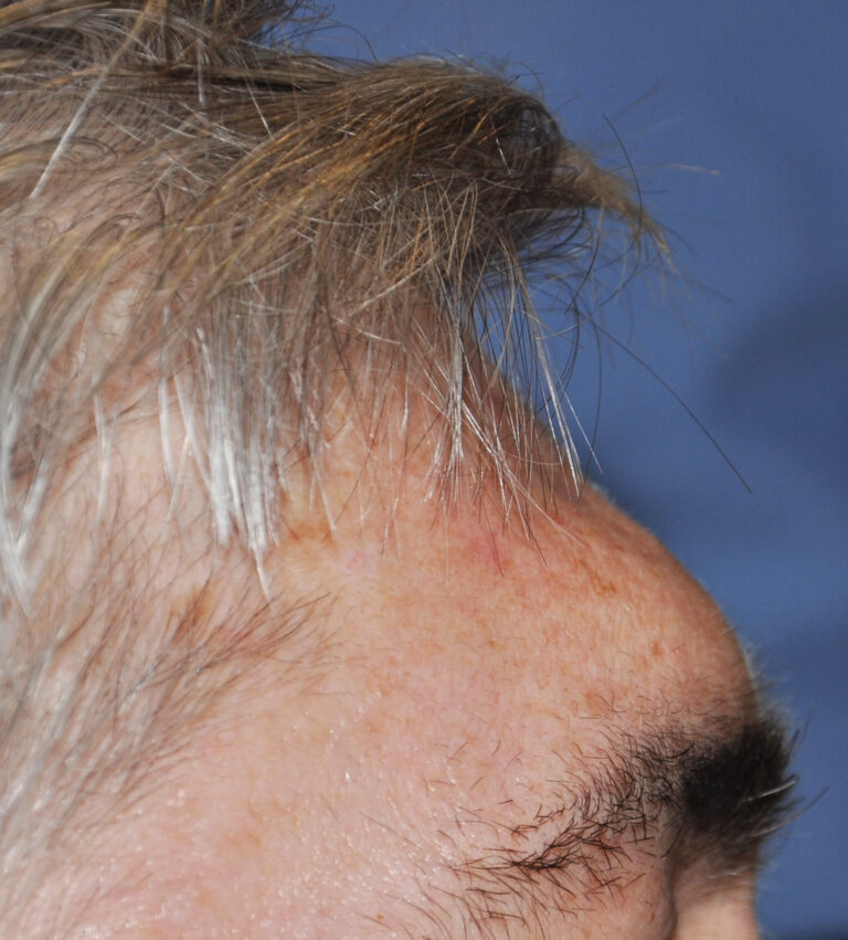 Plastic Surgery Case Study Male 'Brow Bone Reduction' With A