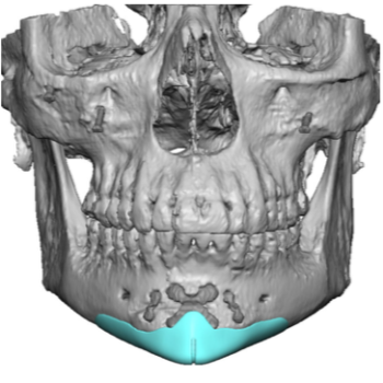 Chin Implant Archives - Explore Plastic Surgery