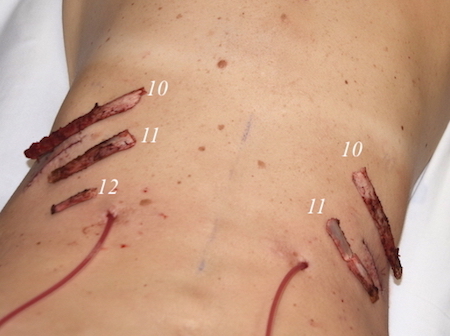 Plastic Surgery Case Study - Rib Removal Surgery for Waist Narrowing with  Absence of Right Rib #12 - Explore Plastic Surgery