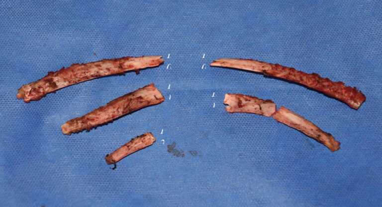 Plastic Surgery Case Study - Rib Removal Surgery for Waist Narrowing