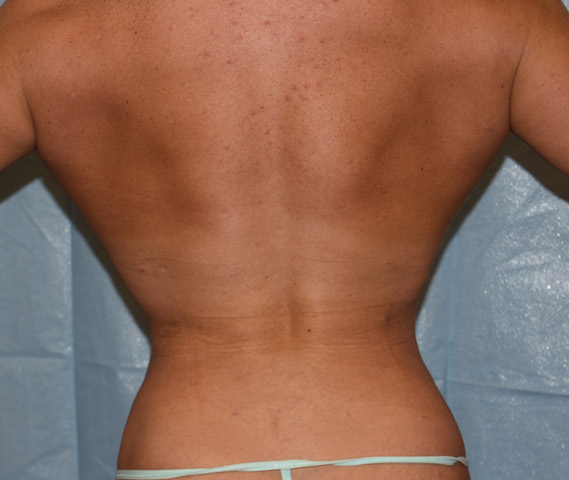 Plastic Surgery Case Study - Waist Reduction In A Female Body Builder Using  Combined Rib Removal and Lat Muscle Resection - Explore Plastic Surgery